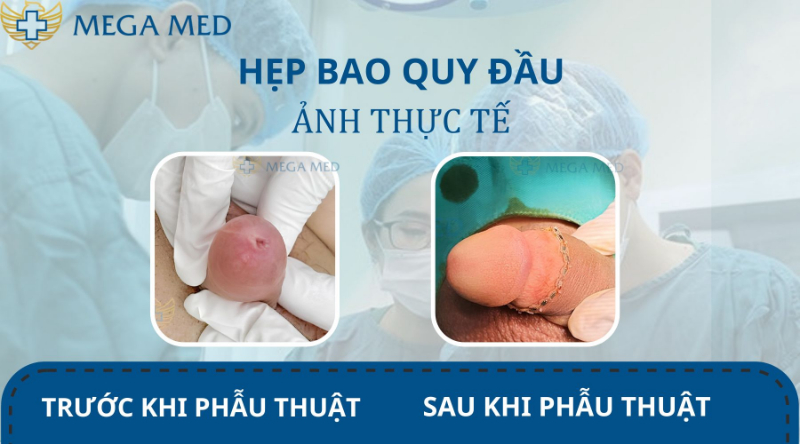 Hình ảnh trước và sau khi cắt hẹp bao quy đầu